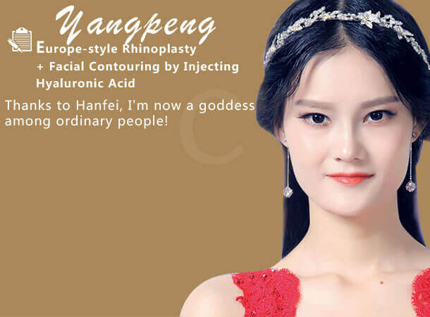 yangpeng Europe-style Rhinoplasty + Facial Contouring by Injecting Hyaluronic Acid